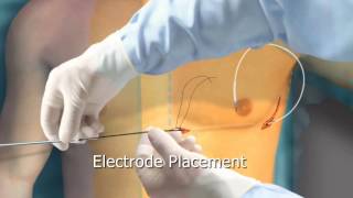 Subcutaneous ICD Animation  Arrhythmiaorg [upl. by Yelsnia]