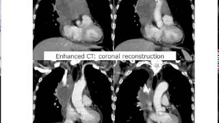 Mediastinal tumor answer ①20150323 WMV [upl. by Boyer]