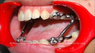 Presenting the Herbst appliance An Introduction  Tom Nasiopoulos Orthodontist [upl. by Crispa]