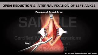 Open Reduction amp Internal Fixation of Left Ankle [upl. by Opiak]