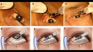 Probing and Dilators of surgical instruments [upl. by Gnil]