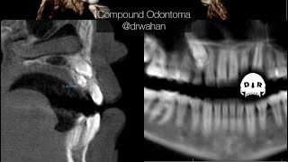 Removal of Compound Odontoma from Palate step by step [upl. by Odradlig255]