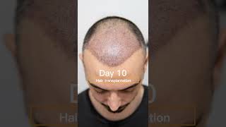 8Month Hair Transplant Results in Istanbul hairtransplant hairtransformation healthtourism [upl. by Loralee]