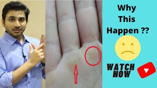 Hard skin on palm of hand  How To Fix Calluses  The Overcompensation Principle  BreatheFit TV [upl. by Engleman]