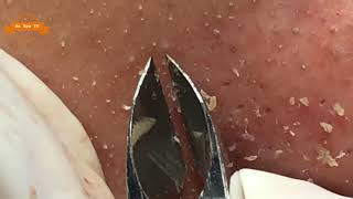 Best Satisfying Nose Plucking Blackheads Whiteheads Removal  Acne Treatment 11 [upl. by Hillary674]