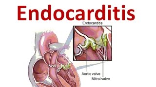 Endocarditis [upl. by Fechter]