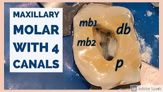 Maxillary Molar with MB2 [upl. by Ethelyn]