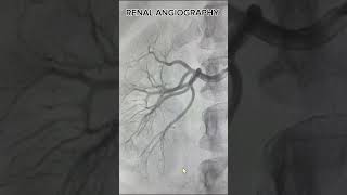 Why might I need a renal angiography [upl. by Aceber711]