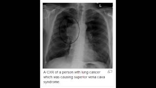 Superior Vena Cava Syndrome [upl. by Harat127]