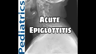 Acute Epiglottitis  Causes  Clinical features  Diagnosis and Treatment MED BABY In HINDI [upl. by Westland]