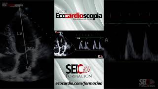 Curso de Ecocardioscopia Ecocardiografía básica [upl. by Siva]