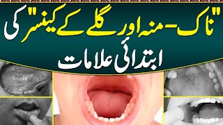 Muh Ke Cancer Ka Ilaj Muh or Galay Ka Cancer Qn Hota Ha  Oral Cancer Causes Symptoms amp Treatment [upl. by Kielty]