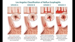 Gastro esophageal reflux disease GERD Heart BurnGrade C reflux esophagitisDr Pandiaraja [upl. by Elyad18]