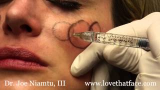 Juverderm Voluma 5 Minute Cheeks by Dr Joe Niamtu III [upl. by Hilario]