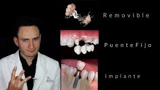 Puentes vs Implantes  ¿Cuál es la mejor opción  Dentista en Querétaro [upl. by Ahsiuqet]