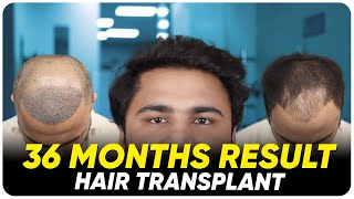 Hair Transplant in Mangalore  Best Results amp Cost of Hair Transplant in Mangalore [upl. by Abramo528]