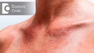 How to avoid and treat Summer Rashes and Stings  Dr Rajdeep Mysore [upl. by Ailalue]