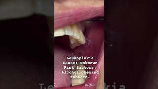 tooth toothdental leukoplakia  oral cancer  smokers  alcohol toothdoctor doctor oral health [upl. by Yevi782]