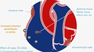 Ação dos antiarrítmicos classe III  wwwarritmiaonlinecombr [upl. by Naffets838]