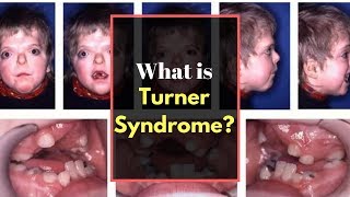 Turner syndrome Symptoms  Causes Pictures Signs and Symptoms of Turners syndrome [upl. by Kancler480]