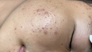 ACNE TREATMENT VU QUYNH MI  Blackheads On Boy Face 2024FULL [upl. by Eisej341]