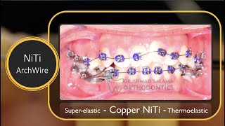 ep15 orthodontic archwire  Niti  copper niti [upl. by Maybelle419]