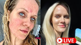 How I cured my ROSACEA naturally [upl. by Schulz]