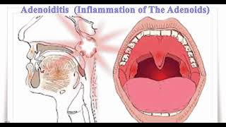 ADENOIDITIS Definition of adenoiditis Causes of adenoiditis Symptoms of adenoiditis✨ [upl. by Enalb]