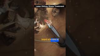 Kidney stone removal  Kidney stone treatment  laser treatment  Rirs  shorts curestone [upl. by Eissat]