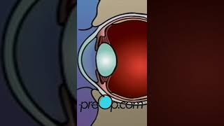 PreOp® 👁️ What to Expect with LASIK Laser Eye Surgery preop shorts health 🌟 [upl. by Austreng]