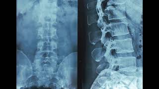 lumbar spine xray intervertebral discs on Xray revisited [upl. by Anaeli28]