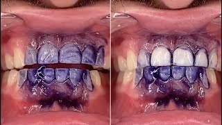 V34 Mousse Teeth Whitening Purple Toothpaste Review  hismile toothpaste [upl. by Gnivri]