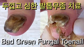 심하게 두꺼운 발톱무좀 치료 Fungal Toenail 휴발 이 살았다 라고 환자분이 말씀하셨어요 [upl. by Hyrup]