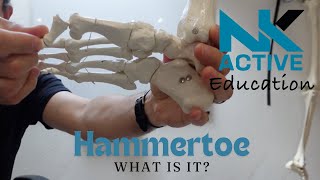 What is hammertoe [upl. by Platto]