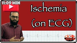 Ischemia ׀ Myocardial Infarction MI ׀ How to diagnose on ECG EKG ׀ dr joos [upl. by Manwell]