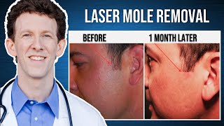 Laser Mole Removal  Live Procedure [upl. by Ynamrej309]