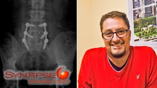 Update  2 Weeks After Lumbar Fusion Surgery [upl. by Kamat]