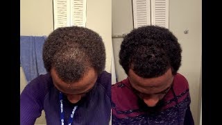 Rogaine Minoxidil Journey  Week 10 [upl. by Gingras]