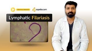 Lymphatic Filariasis  Medicine Lectures  Medical Student  VLearning  sqadiacom [upl. by Ellasal]