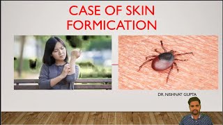 CASE OF SKIN FORMICATION by Dr NISHANT GUPTA [upl. by Olette]