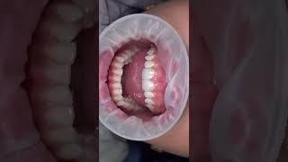 Two ultrathin porcelain veneers made without the slightest reduction of the teeth [upl. by Nomzzaj]