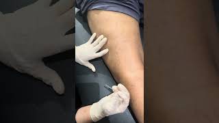 Dry needling  IT band [upl. by Meehahs]