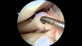 Lateral Meniscus Repair [upl. by Daffi]