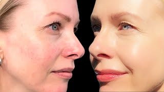 AZELAIC ACID  how to layer in your routine  it FIXED my ROSACEA [upl. by Ebba]