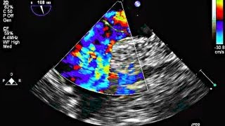 Interatrial Septal Aneurysm and Patent Foramen Ovale  Echocardiography [upl. by Leahcym]