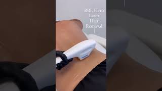 Laser Hair Removal with the BBL Hero Laser [upl. by Christabel]