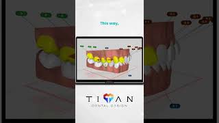 How to select multiple teeth 🦷🦷🦷aligners orthodontics dentist orthodontia dentalcare ortho [upl. by Yro]