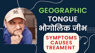 Geographic Tongue Symptoms Causes Treatment  भौगोलिक जीभ  Geographic Tongue in Hindi [upl. by Eindys]