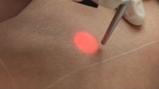 Epilation Laser Paris  Précautions après une séance [upl. by Dacey27]