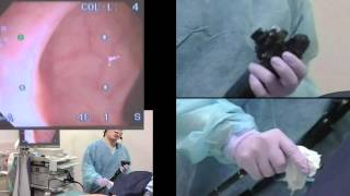 Colonoscopy  consecutive cases 120 [upl. by Zeb]